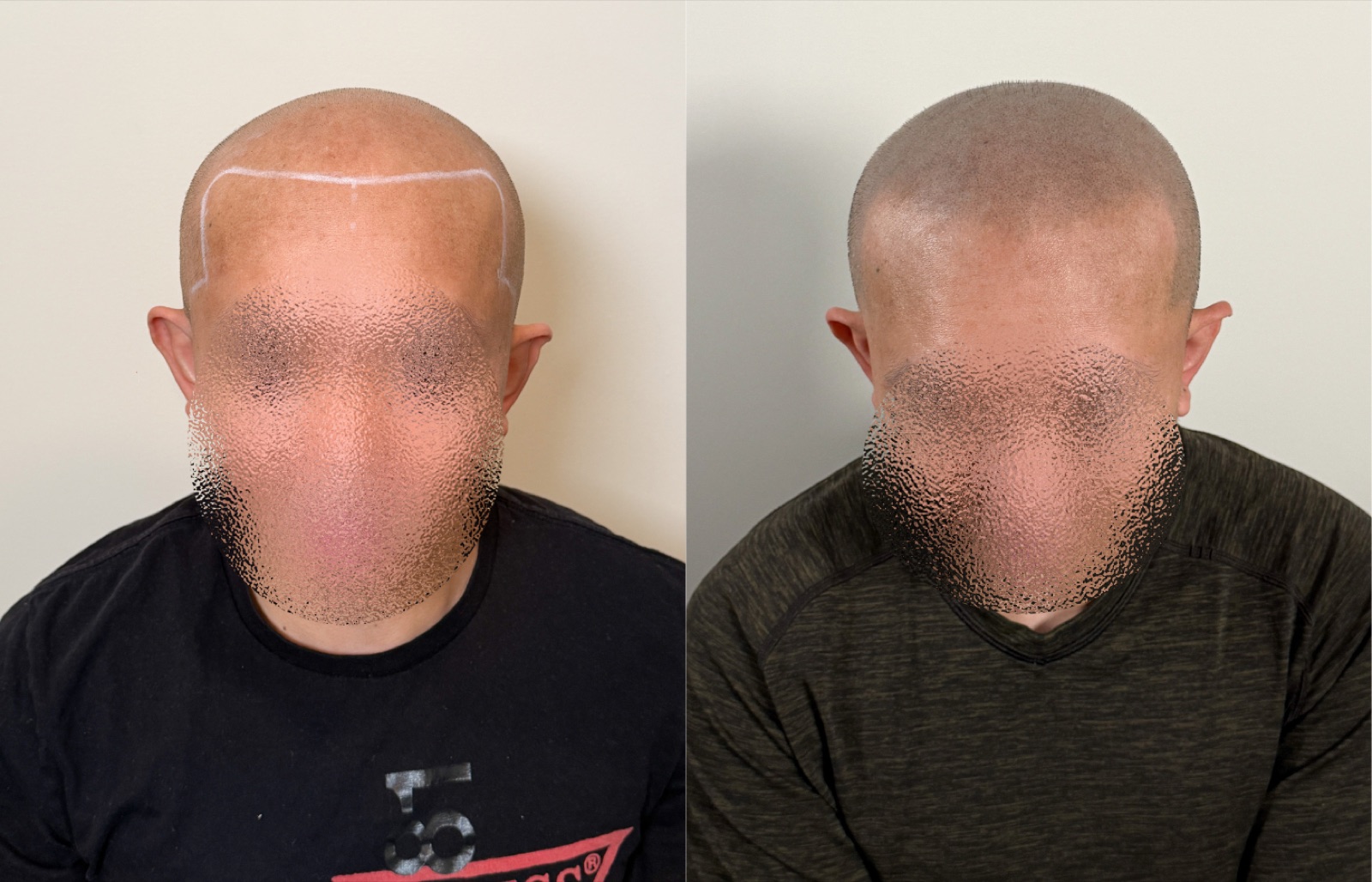Shaved look SMP portfolio 9